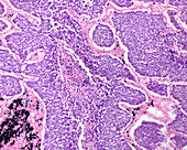 Small cell lung carcinoma, light micrograph