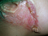 Pyoderma gangrenosum treated with infliximab