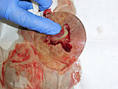 Draining an abscess in hidradenitis suppurativa