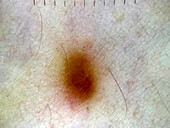 Dermatofibroma, dermoscopy