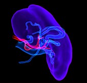 Spleen with splenic artery aneurysm, 3D MRI scan