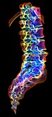 Lumbar and sacral spine, 3D CT scan