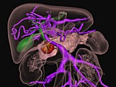 Pancreatic cancer, 3D CT scan