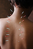 Acupuncture needles in African woman's back, Gaithersburg, MD