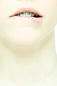 Teenage girl with braces biting lip, extreme close-up