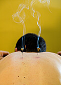 A person recieving a chinese medicine treatment consisting of burning Moxa on an acupuncture needle.