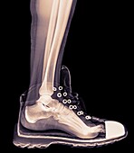 X-Ray of a foot and ankle in a running shoe.