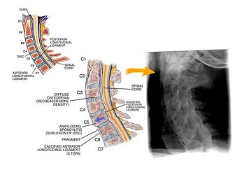 calcification du ligament longitudinal antérieur